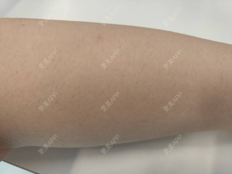 更美 - 更美用户ULBdsFURSw的手臂脱毛经验 | 广州 | 视频日记 | 手臂脱毛