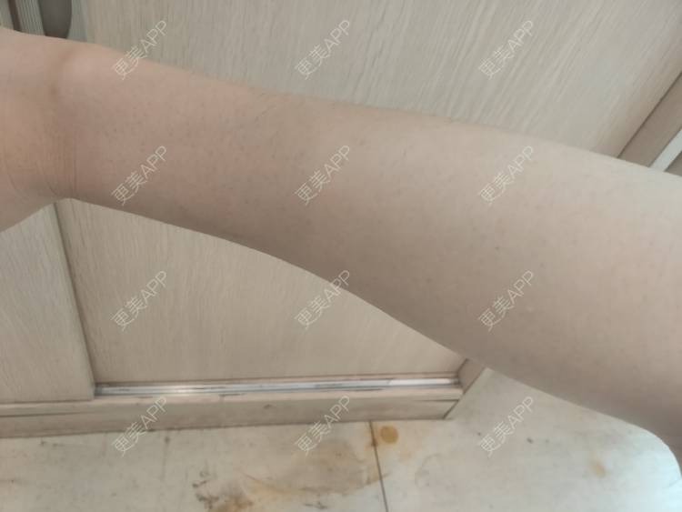更美 - 更美用户ULBdsFURSw的手臂脱毛经验 | 广州 | 视频日记 | 手臂脱毛