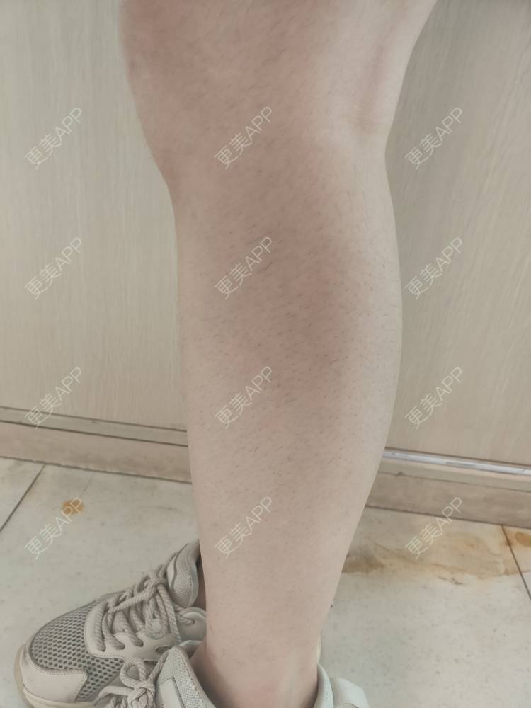 更美 - 更美用户ULBdsFURSw的手臂脱毛经验 | 广州 | 视频日记 | 手臂脱毛