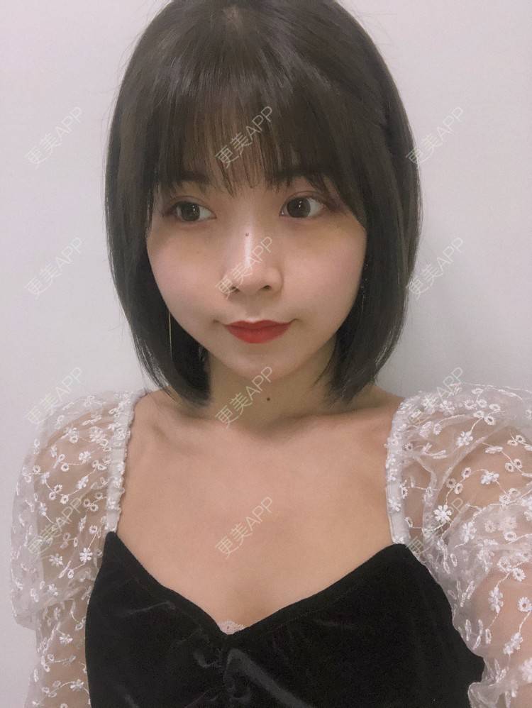 更美 - 更美用户qGSX4259xW的定点双眼皮经验 | 成都 | 视频日记 | 定点双眼皮