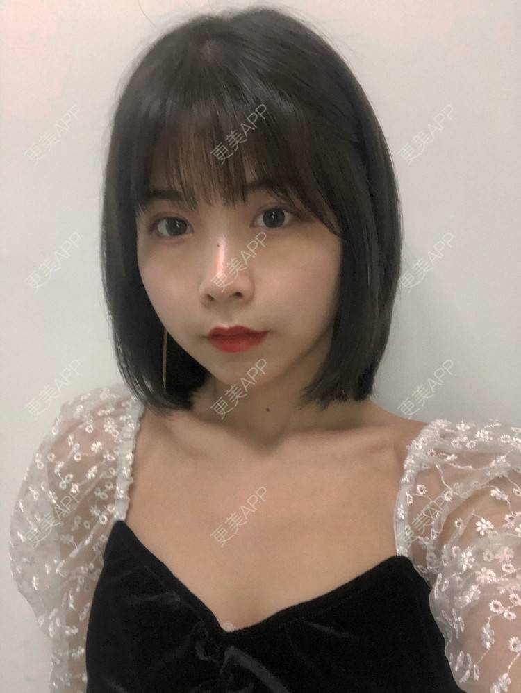 更美 - 更美用户qGSX4259xW的定点双眼皮经验 | 成都 | 视频日记 | 定点双眼皮