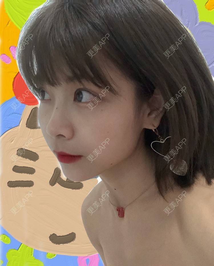 更美 - 更美用户qGSX4259xW的定点双眼皮经验 | 成都 | 视频日记 | 定点双眼皮