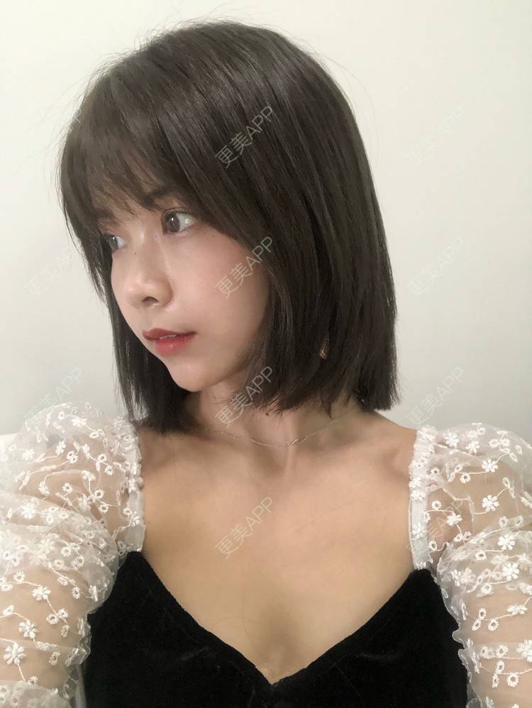 更美 - 更美用户qGSX4259xW的定点双眼皮经验 | 成都 | 视频日记 | 定点双眼皮