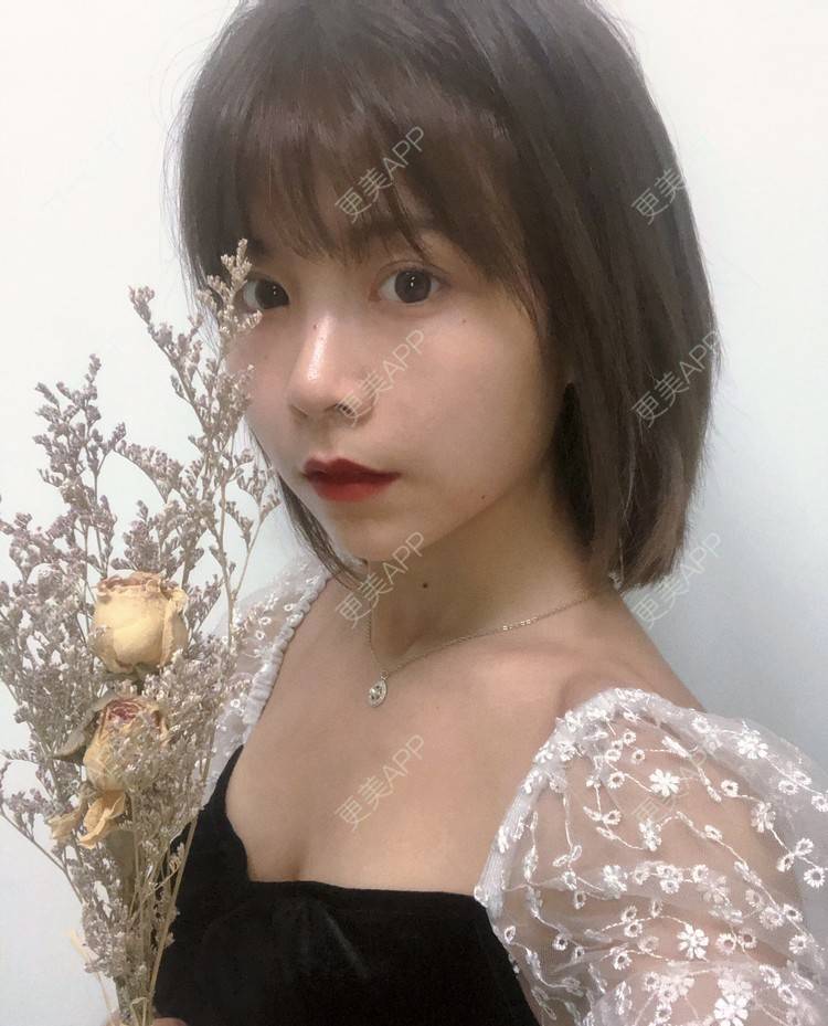 更美 - 更美用户qGSX4259xW的定点双眼皮经验 | 成都 | 视频日记 | 定点双眼皮