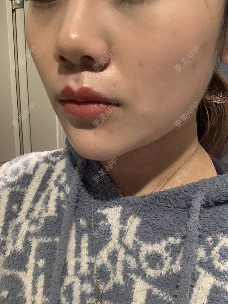 更美 - Migy-x的酒窝成形经验 | 酒窝成形 | 重庆