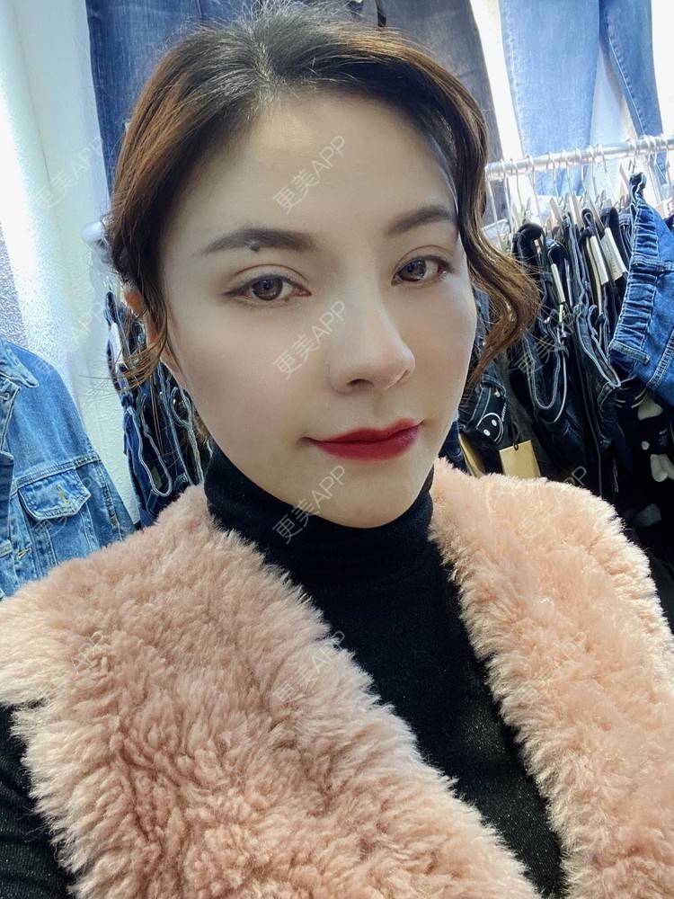 更美 - 更美用户cYoCneHuFl的鼻部多项经验 | 阳江 | 鼻部多项