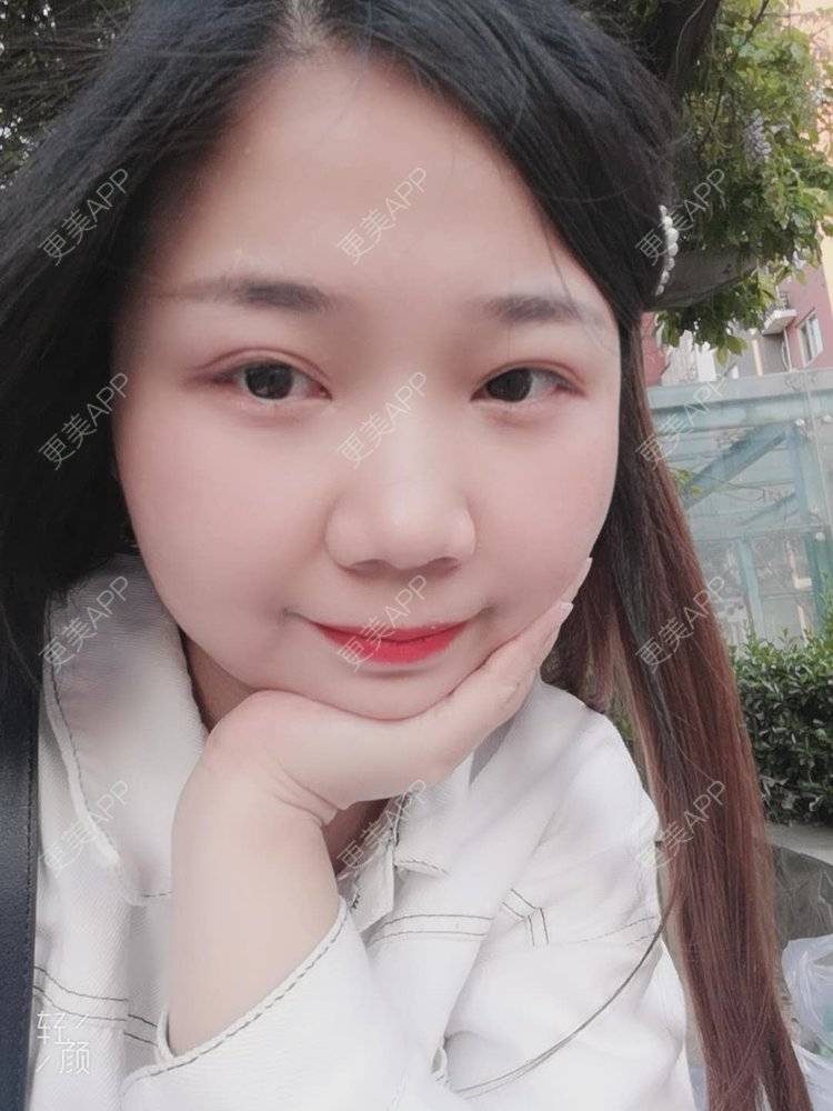 更美 - 更美用户9KxkcJyF89的内切去眼袋经验 | 北京 | 眶隔脂肪释放 | 射频去眼袋 | 内切去眼袋 | 激光去眼袋