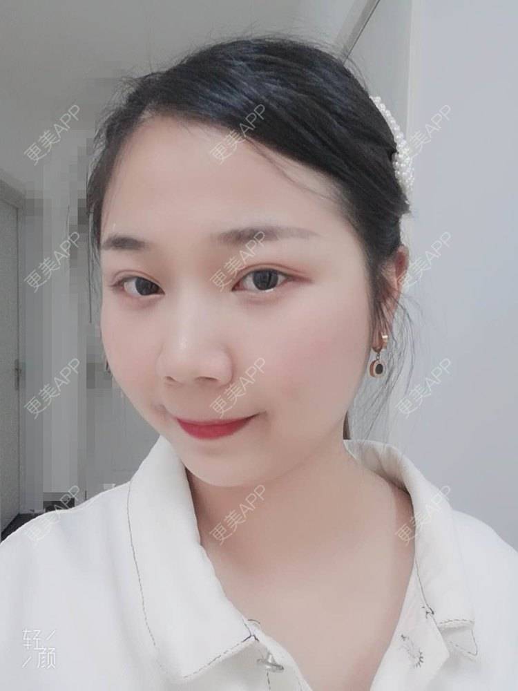 更美 - 更美用户9KxkcJyF89的内切去眼袋经验 | 北京 | 眶隔脂肪释放 | 射频去眼袋 | 内切去眼袋 | 激光去眼袋