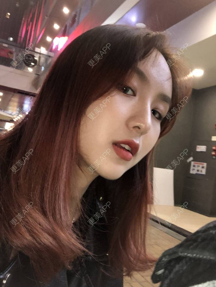 更美 - 更美用户aujlWhrgzx的鼻部多项经验 | 广州 | 鼻部多项