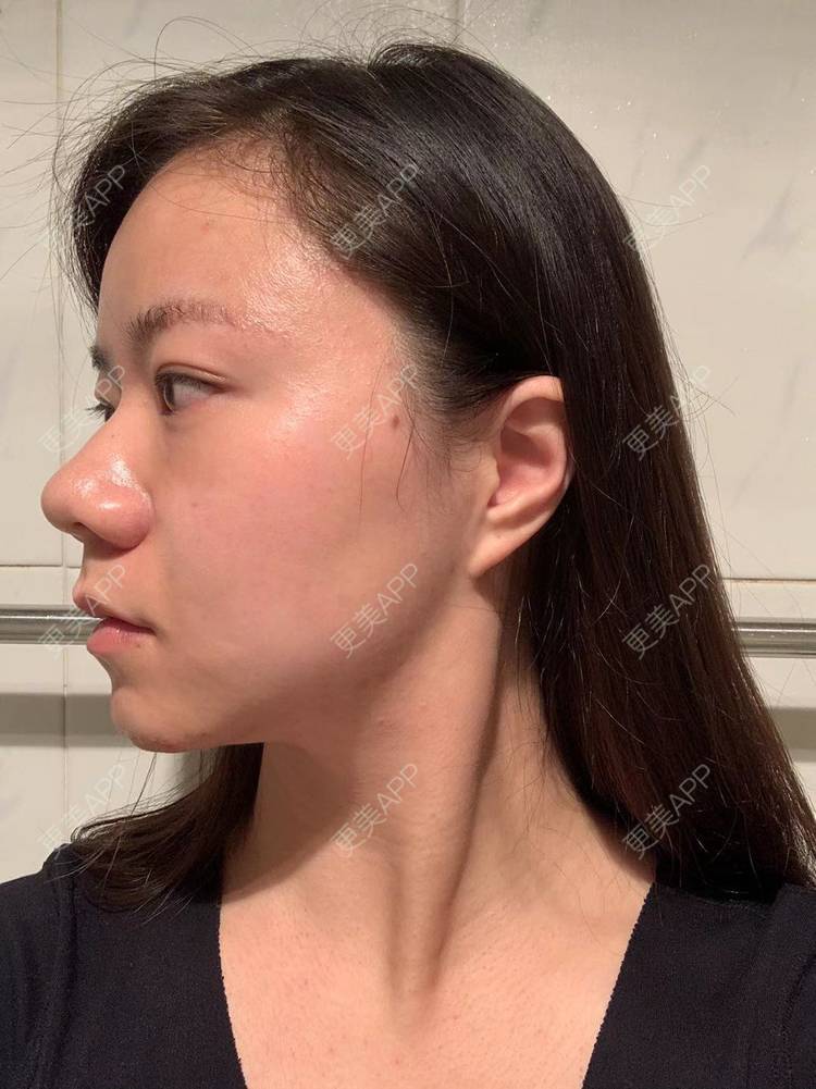 更美 - 更美用户pkMawECeYz的颈部经验 | 热玛吉 | 超声提升 | 除皱 | 颈部 | 除皱套餐