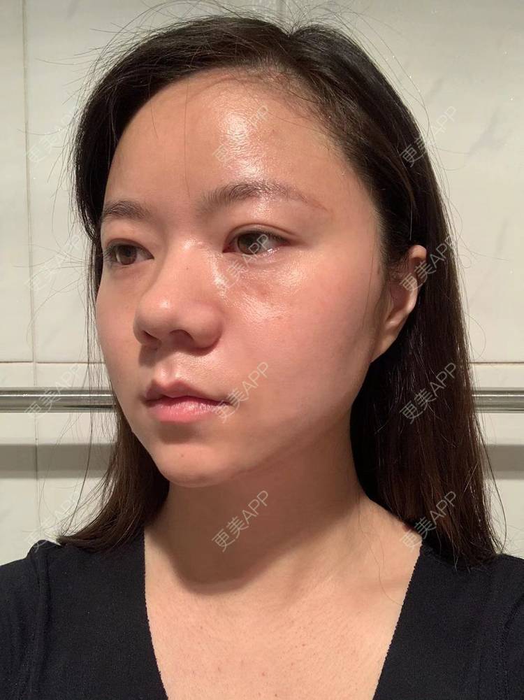 更美 - 更美用户pkMawECeYz的颈部经验 | 热玛吉 | 超声提升 | 除皱 | 颈部 | 除皱套餐