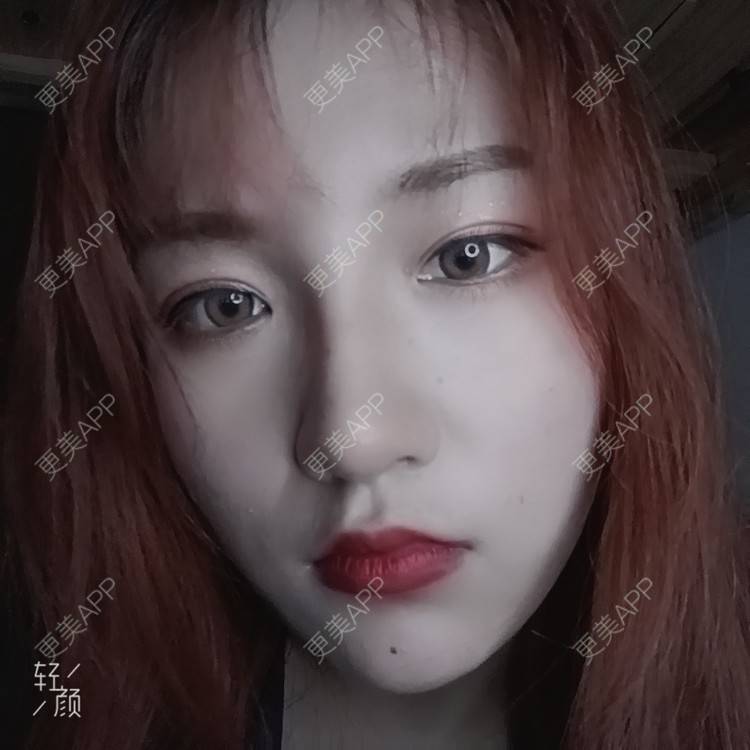 更美 - 更美用户tbs28rKiLZ的玻尿酸卧蚕经验 | 玻尿酸卧蚕 | 杭州