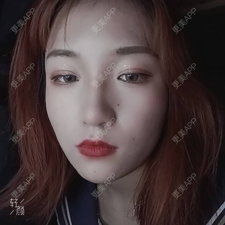 更美 - 更美用户tbs28rKiLZ的玻尿酸卧蚕经验 | 玻尿酸卧蚕 | 杭州
