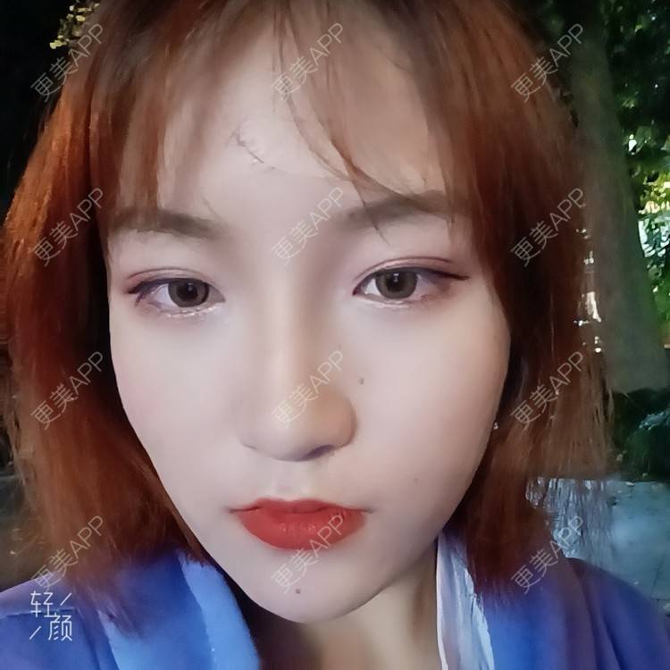 更美 - 更美用户tbs28rKiLZ的玻尿酸卧蚕经验 | 玻尿酸卧蚕 | 杭州