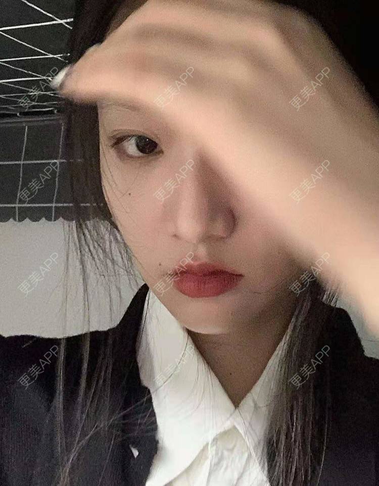 更美 - 就算心丢了也要爱你厥的肩部吸脂经验 | 北京 | 肩部吸脂