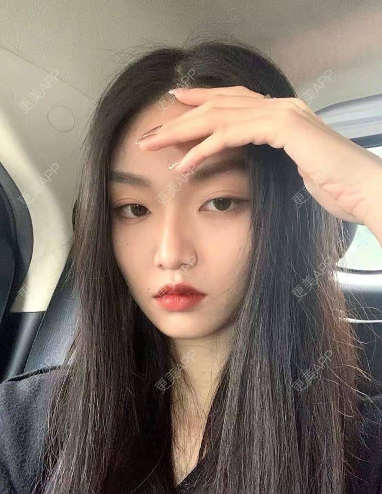 更美 - 就算心丢了也要爱你厥的肩部吸脂经验 | 北京 | 肩部吸脂