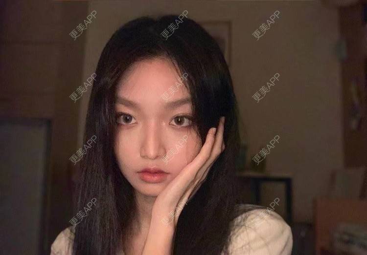 更美 - 就算心丢了也要爱你厥的肩部吸脂经验 | 北京 | 肩部吸脂