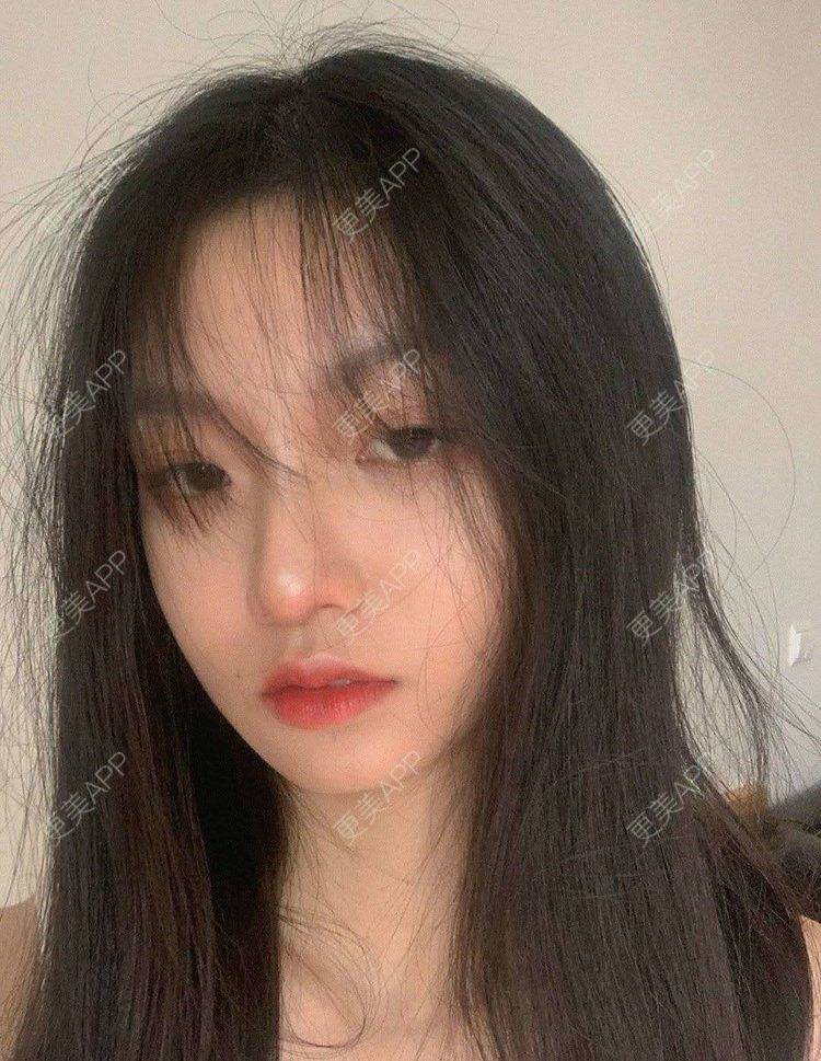 更美 - 就算心丢了也要爱你厥的肩部吸脂经验 | 北京 | 肩部吸脂
