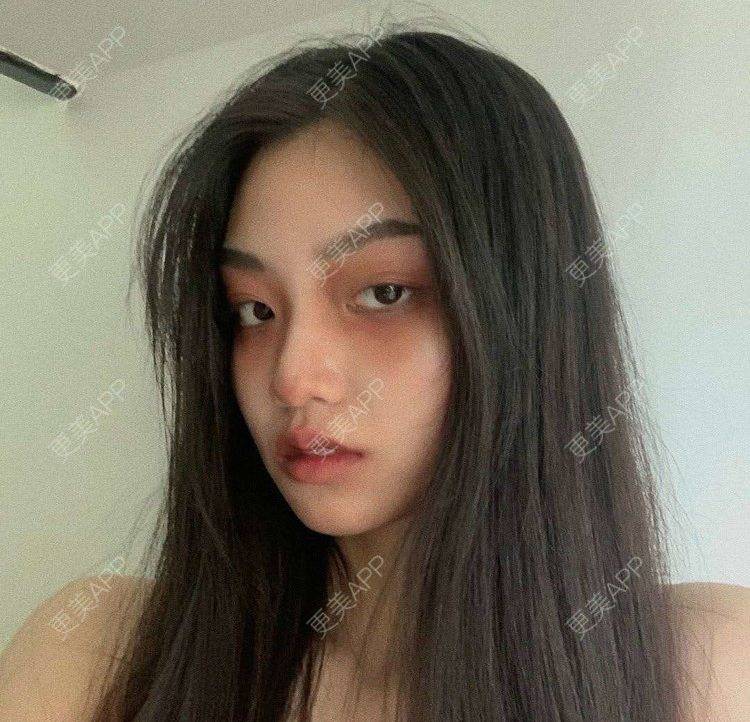 更美 - 就算心丢了也要爱你厥的肩部吸脂经验 | 北京 | 肩部吸脂