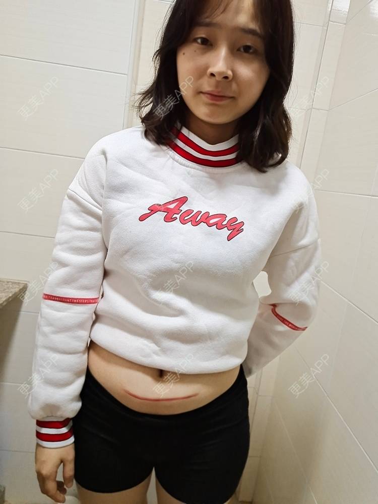 更美 - 更美用户Qq4mVjXUQq的激光淡疤经验 | 手术淡疤 | 注射淡疤 | 激光淡疤 | 成都