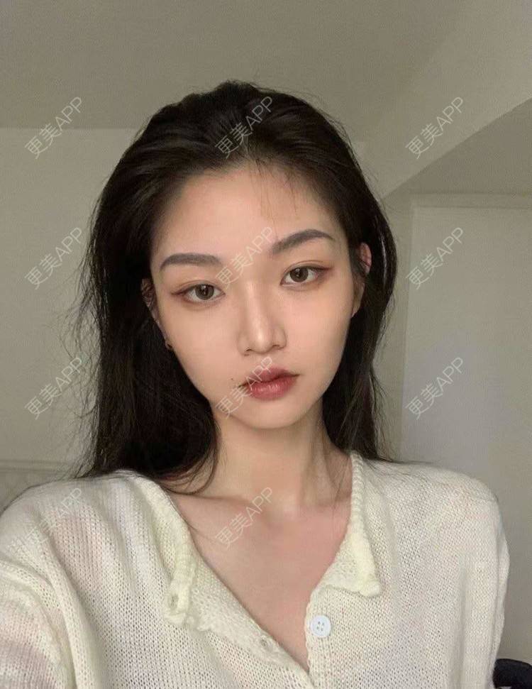 更美 - 就算心丢了也要爱你厥的肩部吸脂经验 | 北京 | 肩部吸脂