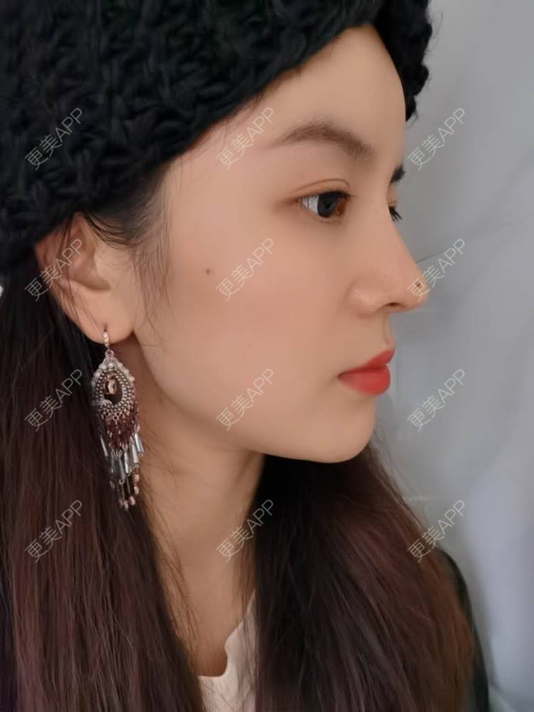 更美 - 金色的丝的鼻部多项经验 | 肋软骨隆鼻 | 自体肋软骨垫鼻基底 | 鼻部多项 | 鼻小柱延长 | 膨体隆鼻 | 武汉