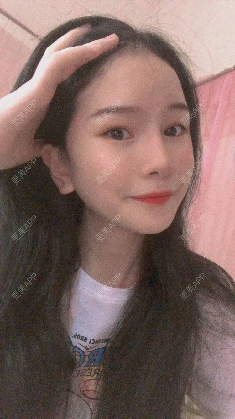 更美 - 更美用户1hOuWDVG0V的下颌角经验 | 成都 | 下颌角
