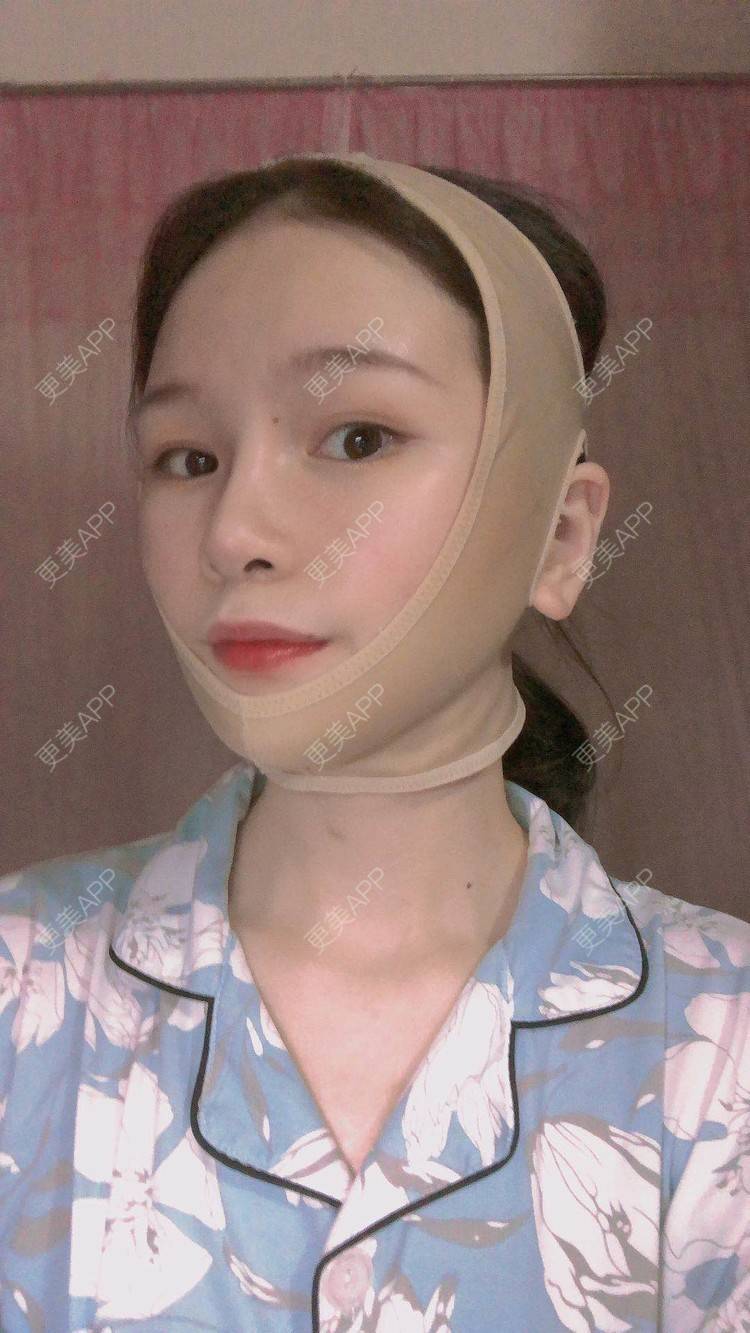 更美 - 更美用户1hOuWDVG0V的下颌角经验 | 成都 | 下颌角