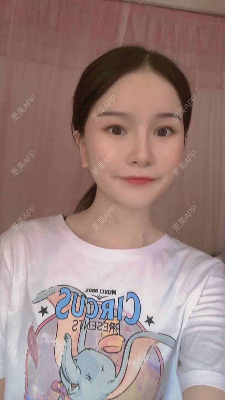 更美 - 更美用户1hOuWDVG0V的下颌角经验 | 成都 | 下颌角