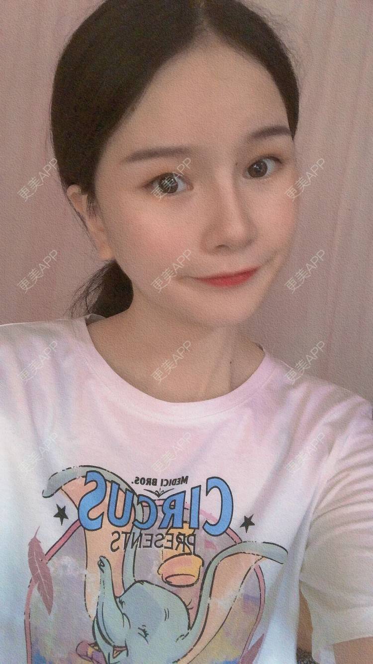 更美 - 更美用户1hOuWDVG0V的下颌角经验 | 成都 | 下颌角