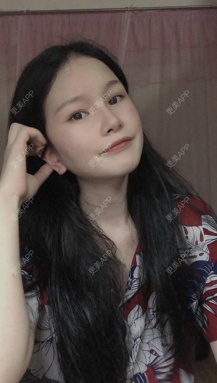更美 - 更美用户1hOuWDVG0V的下颌角经验 | 成都 | 下颌角