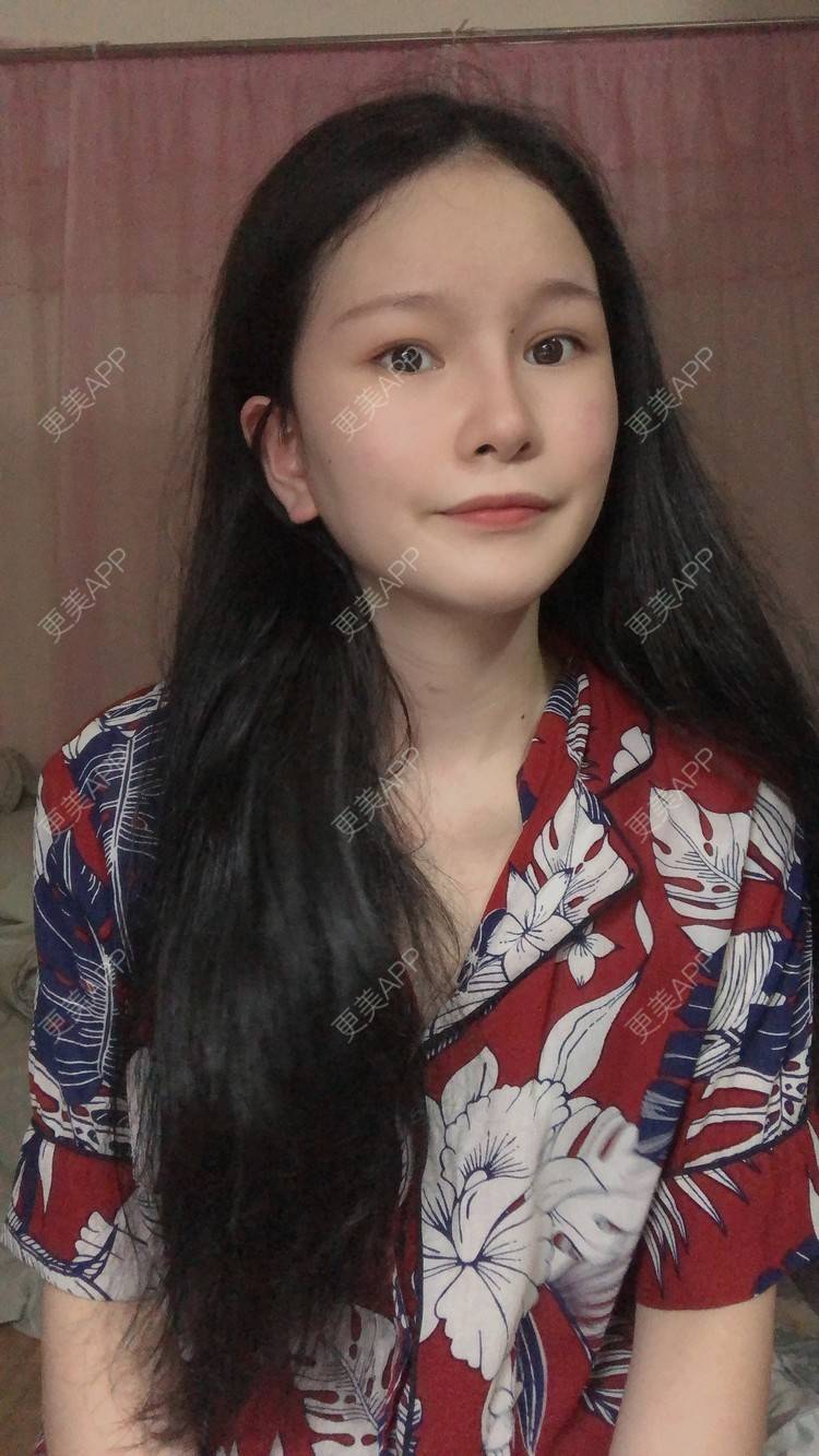 更美 - 更美用户1hOuWDVG0V的下颌角经验 | 成都 | 下颌角