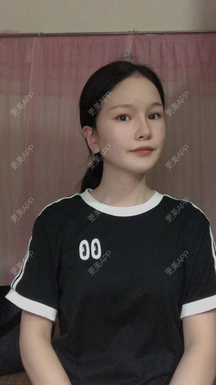 更美 - 更美用户1hOuWDVG0V的下颌角经验 | 成都 | 下颌角