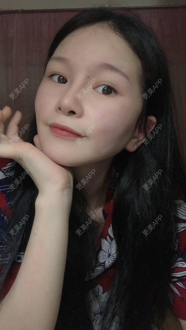 更美 - 更美用户1hOuWDVG0V的下颌角经验 | 成都 | 下颌角