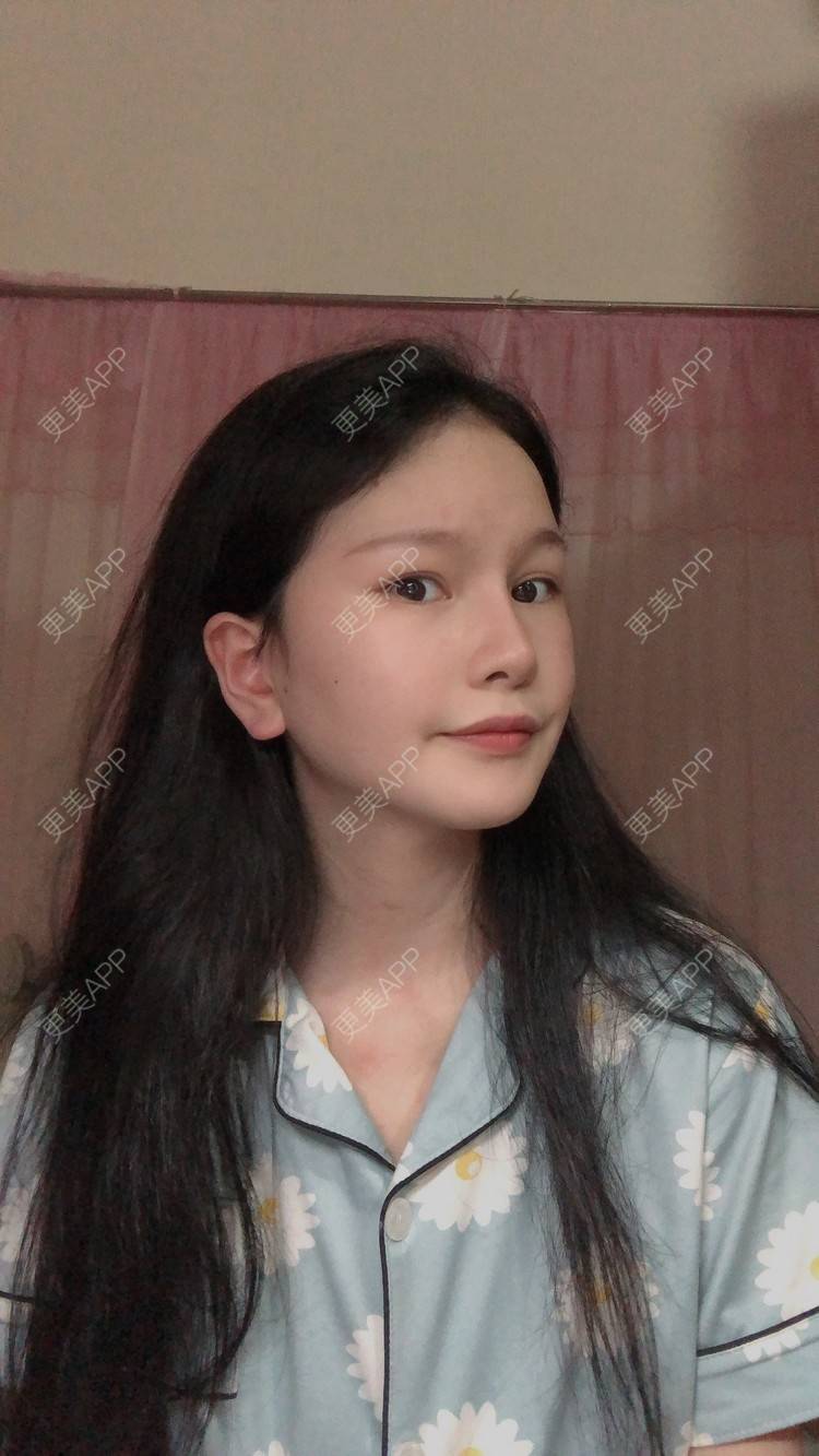 更美 - 更美用户1hOuWDVG0V的下颌角经验 | 成都 | 下颌角