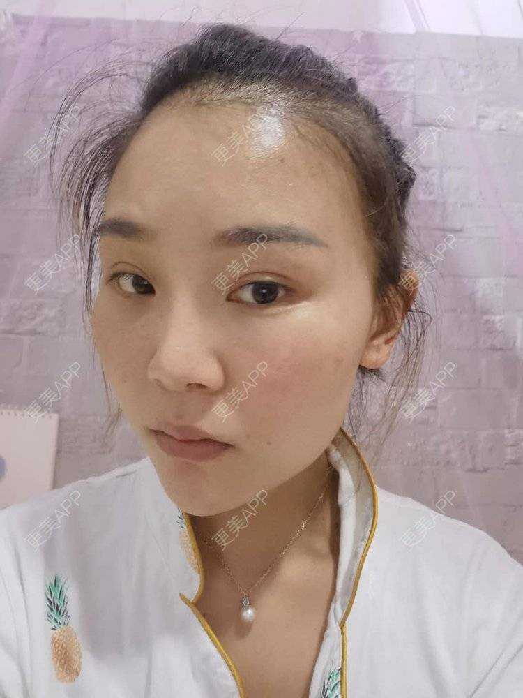 更美 - 更美用户wOARiRO1Ls的真皮丰卧蚕经验 | 北京 | 视频日记 | 真皮丰卧蚕