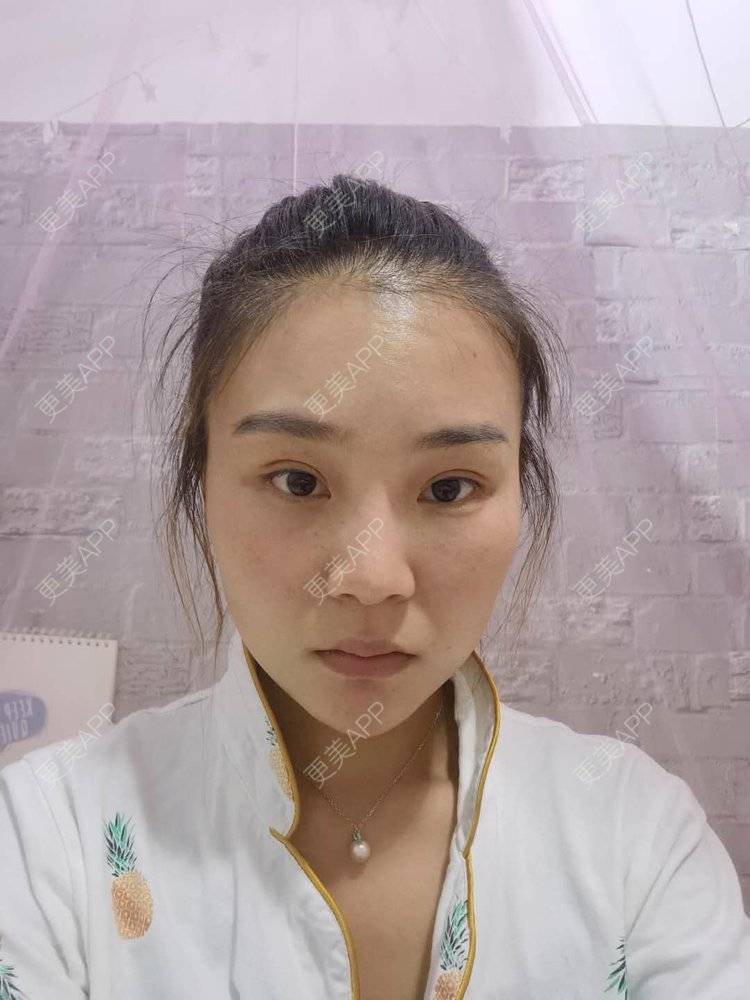 更美 - 更美用户wOARiRO1Ls的真皮丰卧蚕经验 | 北京 | 视频日记 | 真皮丰卧蚕