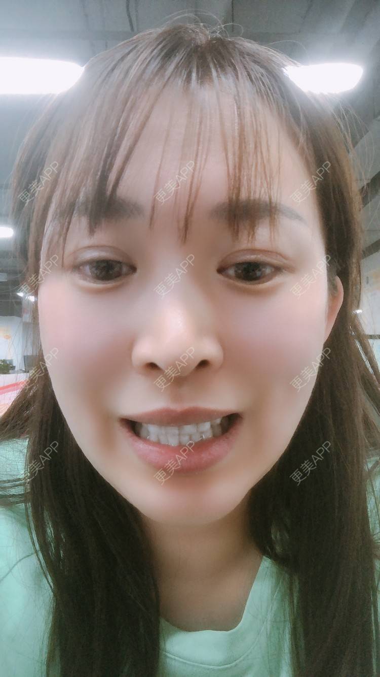更美 - 更美用户nOSa2OXrxm的冷光美白经验 | 北京 | 冷光美白