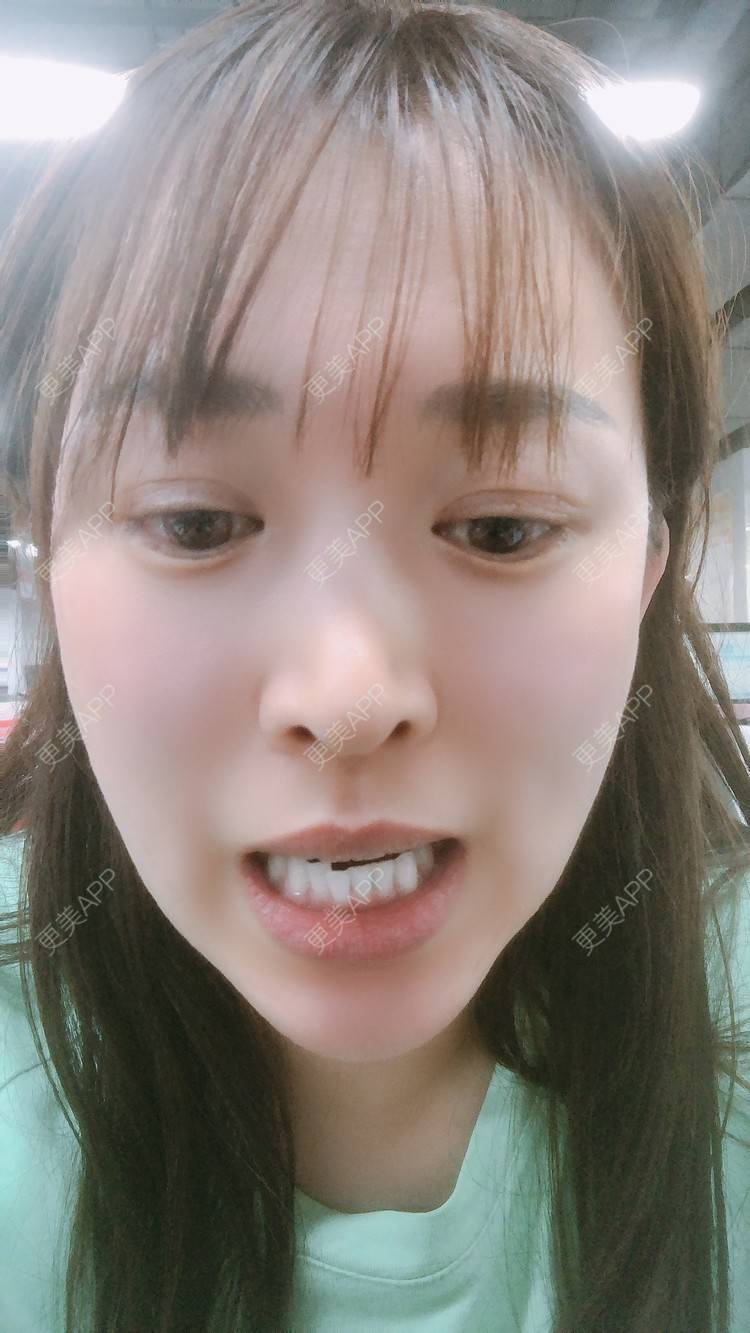 更美 - 更美用户nOSa2OXrxm的冷光美白经验 | 北京 | 冷光美白