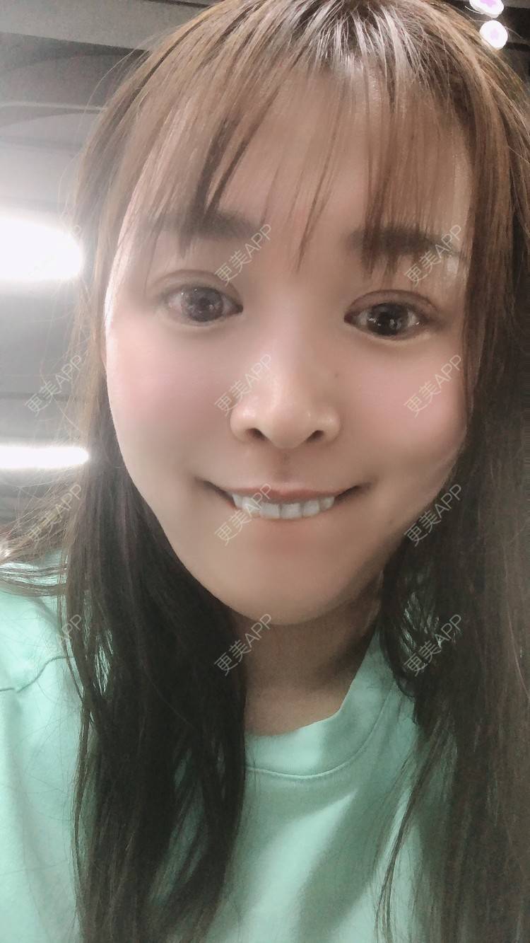 更美 - 更美用户nOSa2OXrxm的冷光美白经验 | 北京 | 冷光美白