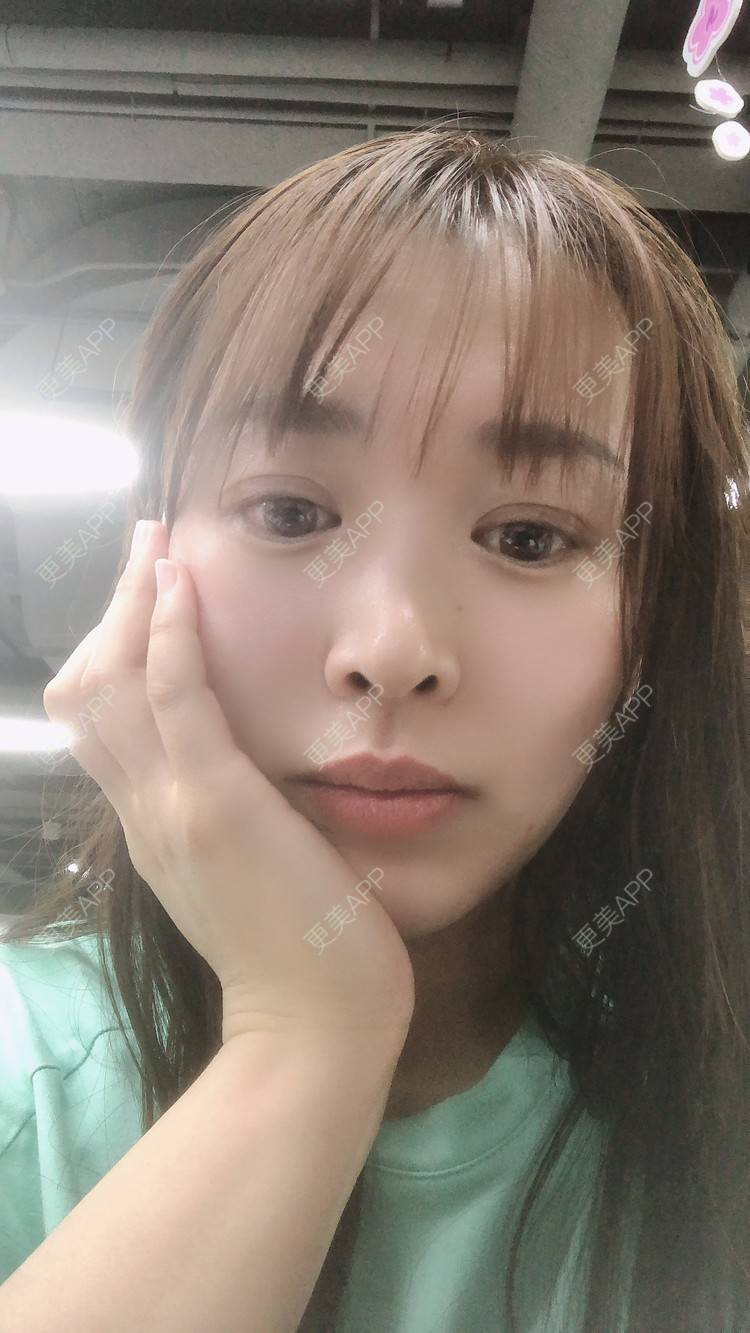 更美 - 更美用户nOSa2OXrxm的冷光美白经验 | 北京 | 冷光美白