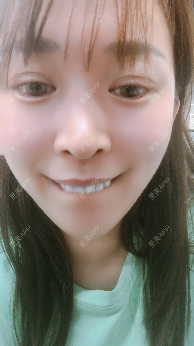 更美 - 更美用户nOSa2OXrxm的冷光美白经验 | 北京 | 冷光美白