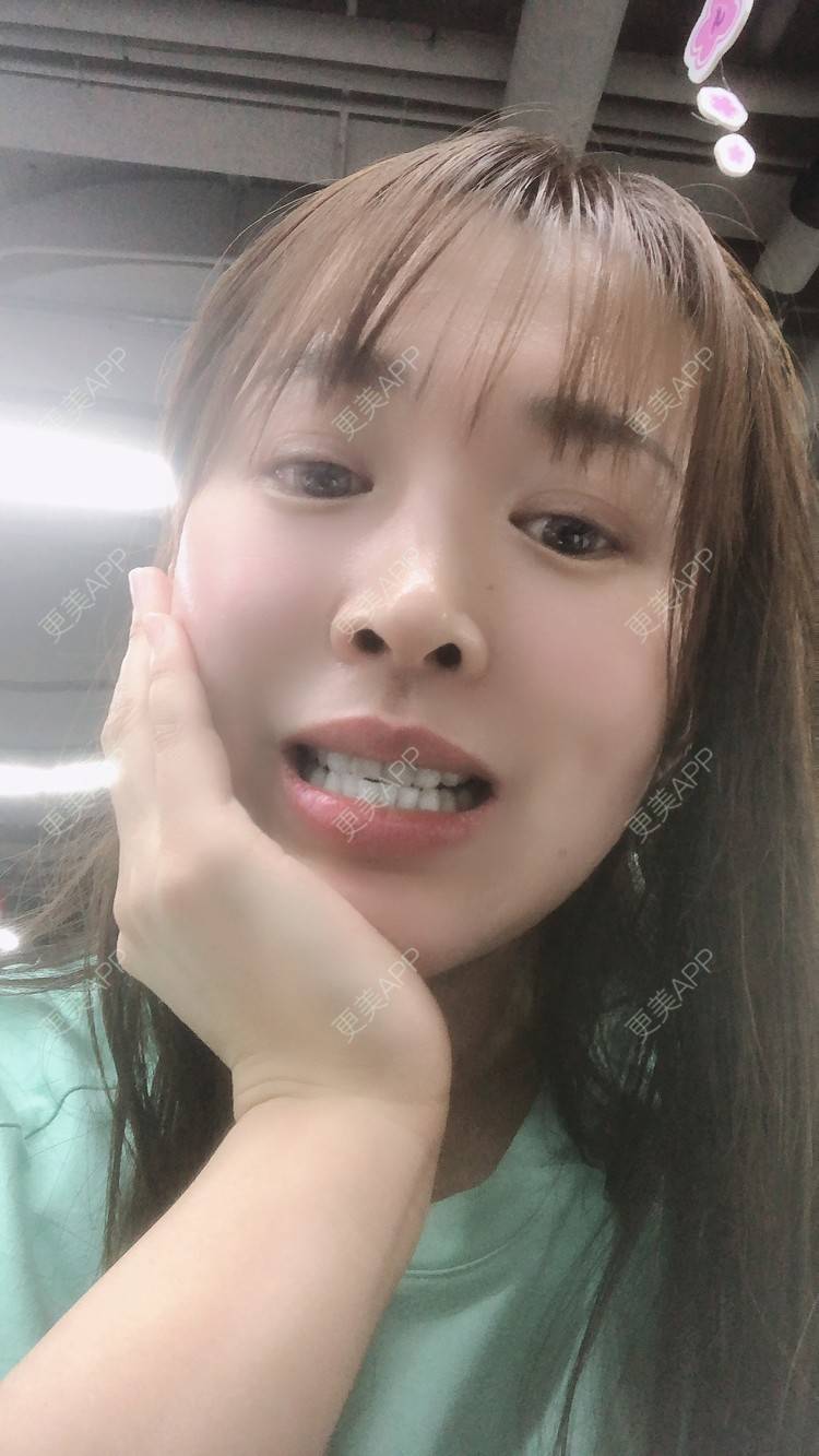 更美 - 更美用户nOSa2OXrxm的冷光美白经验 | 北京 | 冷光美白