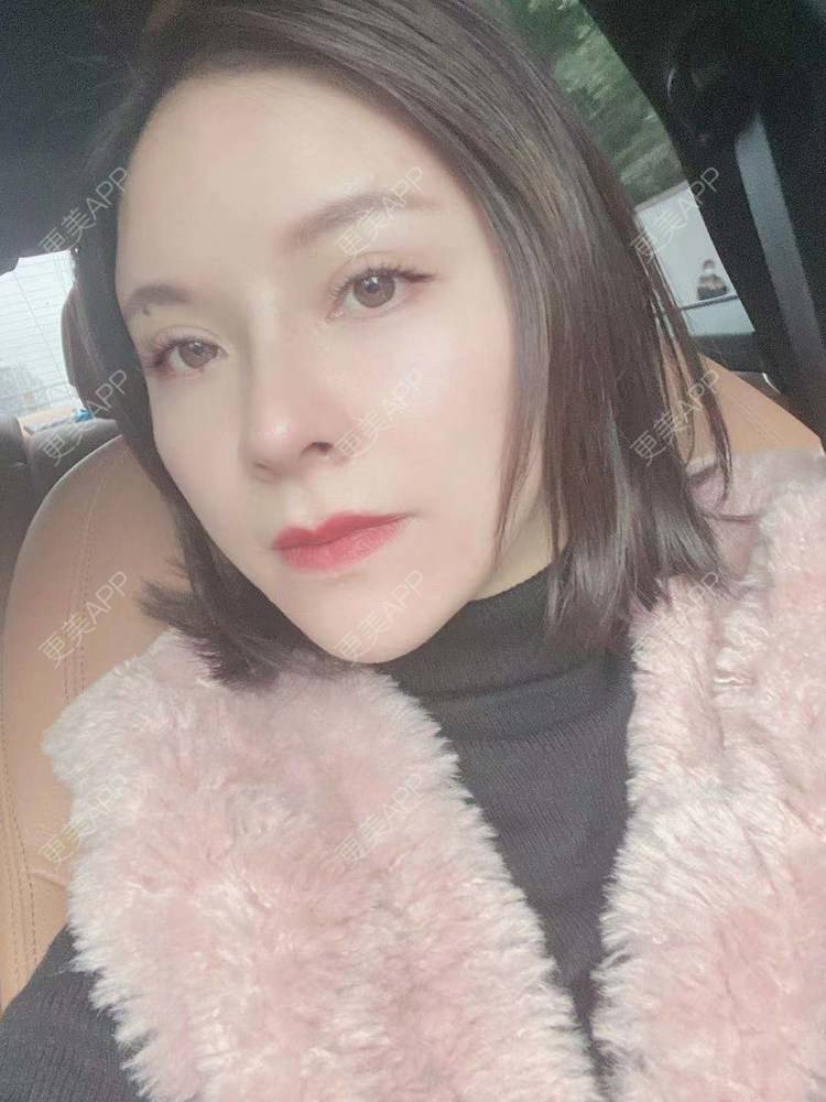 更美 - 更美用户cYoCneHuFl的鼻部多项经验 | 阳江 | 鼻部多项