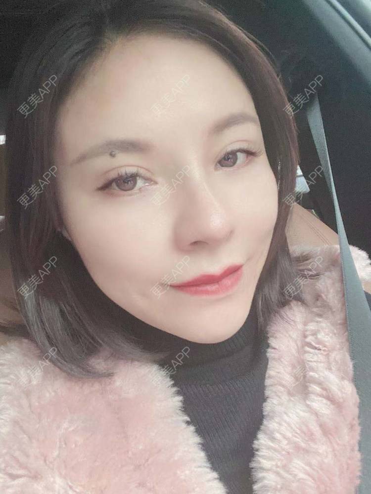 更美 - 更美用户cYoCneHuFl的鼻部多项经验 | 阳江 | 鼻部多项