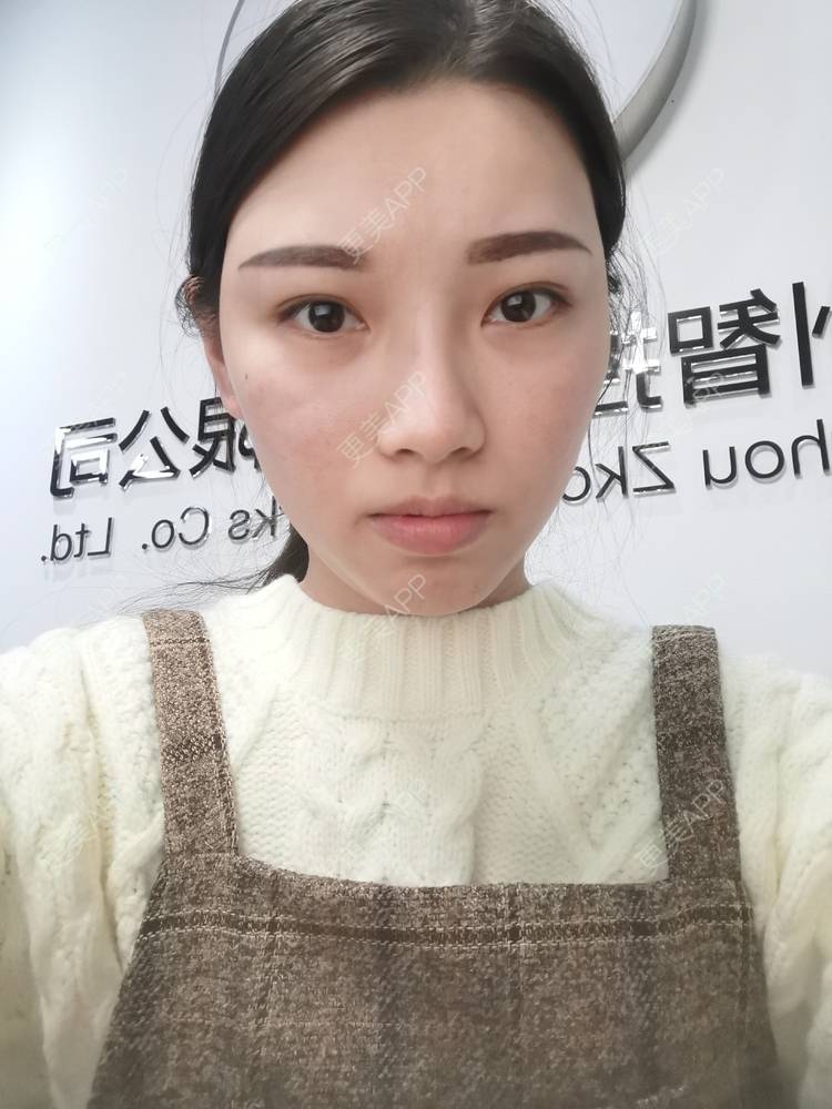 更美 - 更美用户82701801的隐形牙齿矫正经验 | 杭州