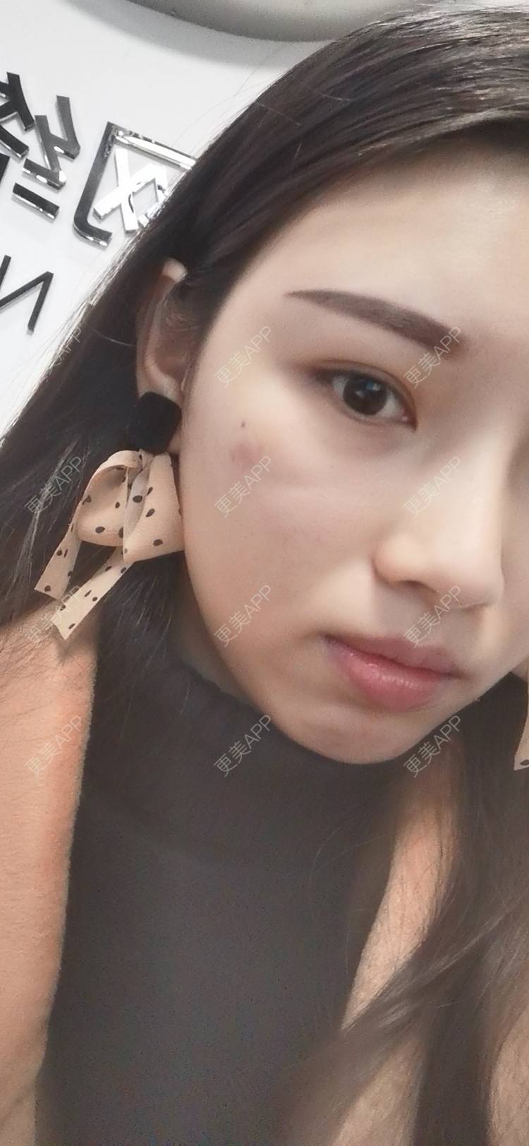 更美 - 更美用户82701801的隐形牙齿矫正经验 | 杭州