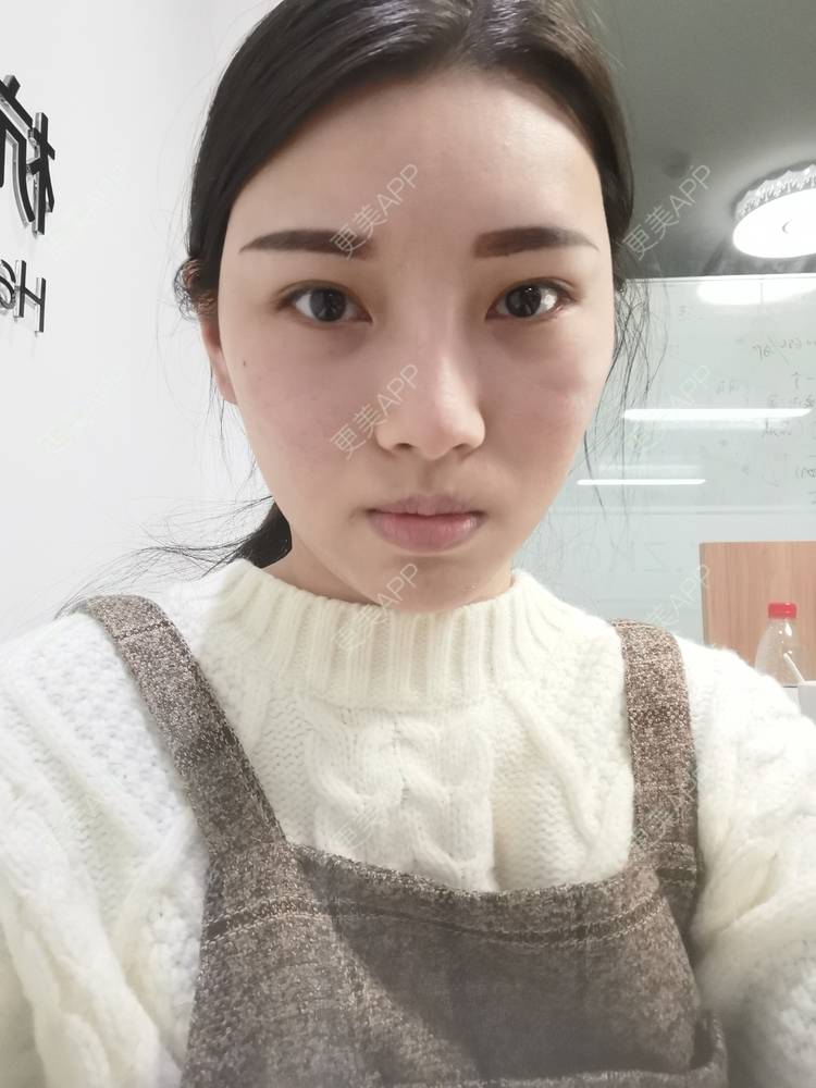 更美 - 更美用户82701801的隐形牙齿矫正经验 | 杭州