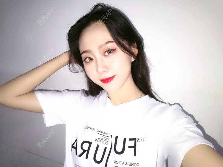 更美 - 更美用户vFETzv4uga的自体脂肪全面部填充经验 | 广州 | 自体脂肪全面部填充 | 视频日记