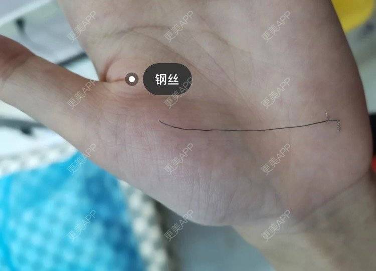 更美 - 婉青儿的凸嘴矫正经验 | 广州 | 凸嘴矫正 | 面部不对称矫正 | 视频日记